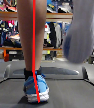 Underpronation